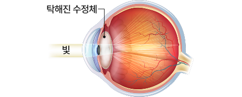 백내장
