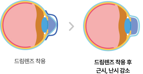 드림렌즈