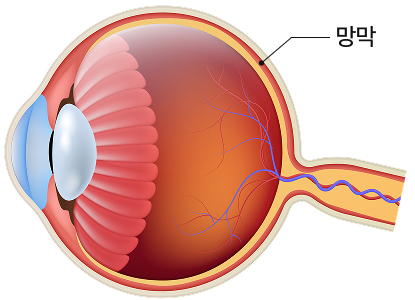 망막질환