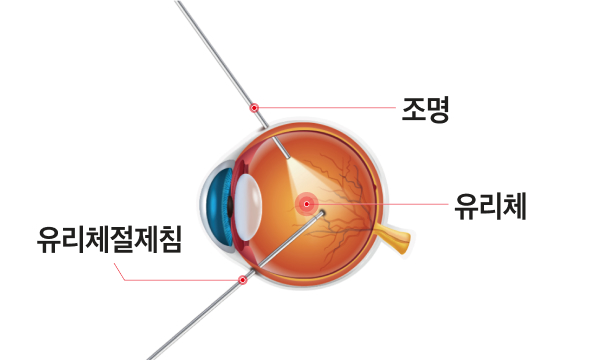 망막레이저술