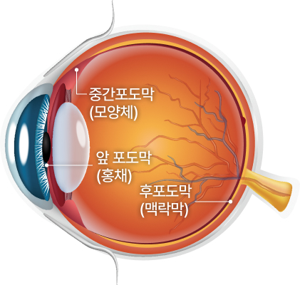 포도막염원인