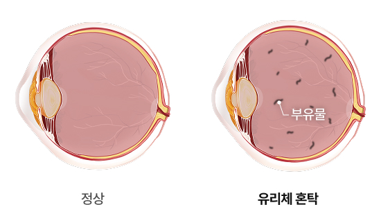 비문증원인