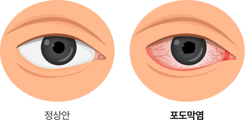 포도막염