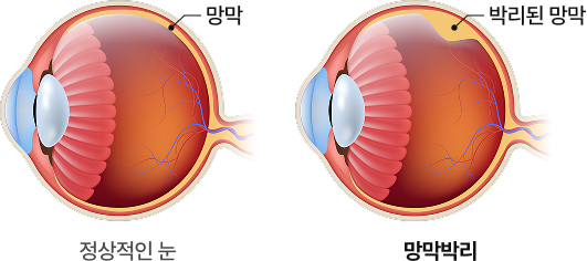 망막박리