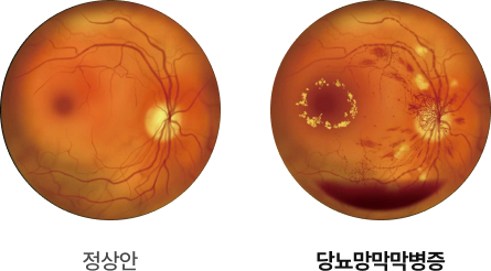 당뇨망막병증