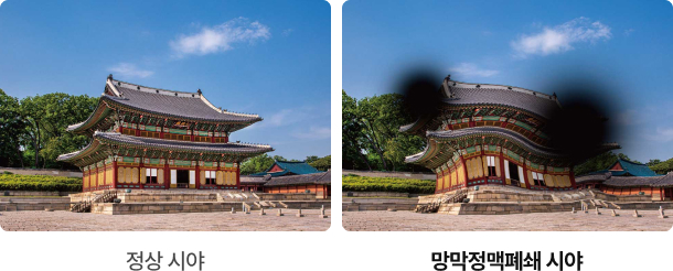 망막혈관폐쇄