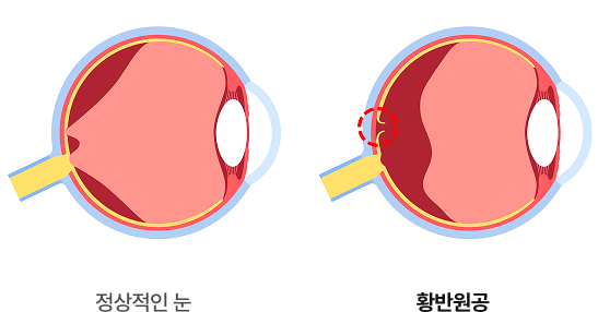 황반원공