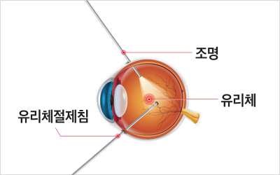 유리체 절제술